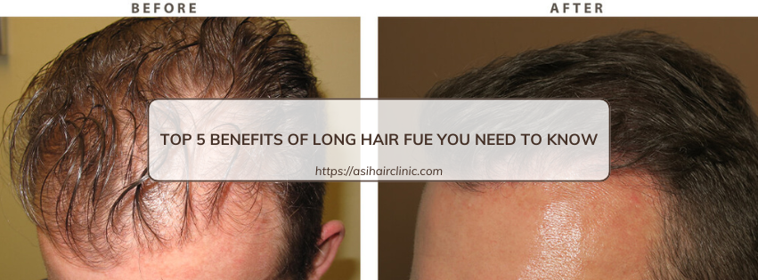 Top 5 Benefits of Long Hair FUE You Need to Know