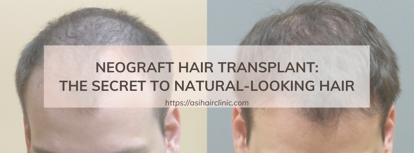 NeoGraft Hair Transplant: The Secret to Natural-Looking Hair