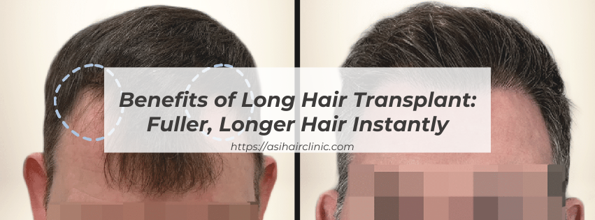 Benefits of Long Hair Transplant: Fuller, Longer Hair Instantly