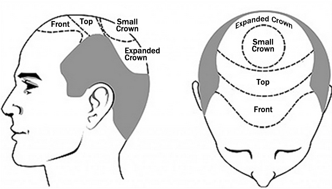 Hair Transplant